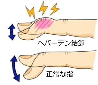 ヘバーデン結節