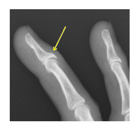 ヘバーデン結節・ブシャール結節