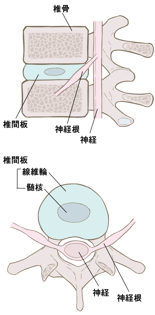 椎間板ヘルニア