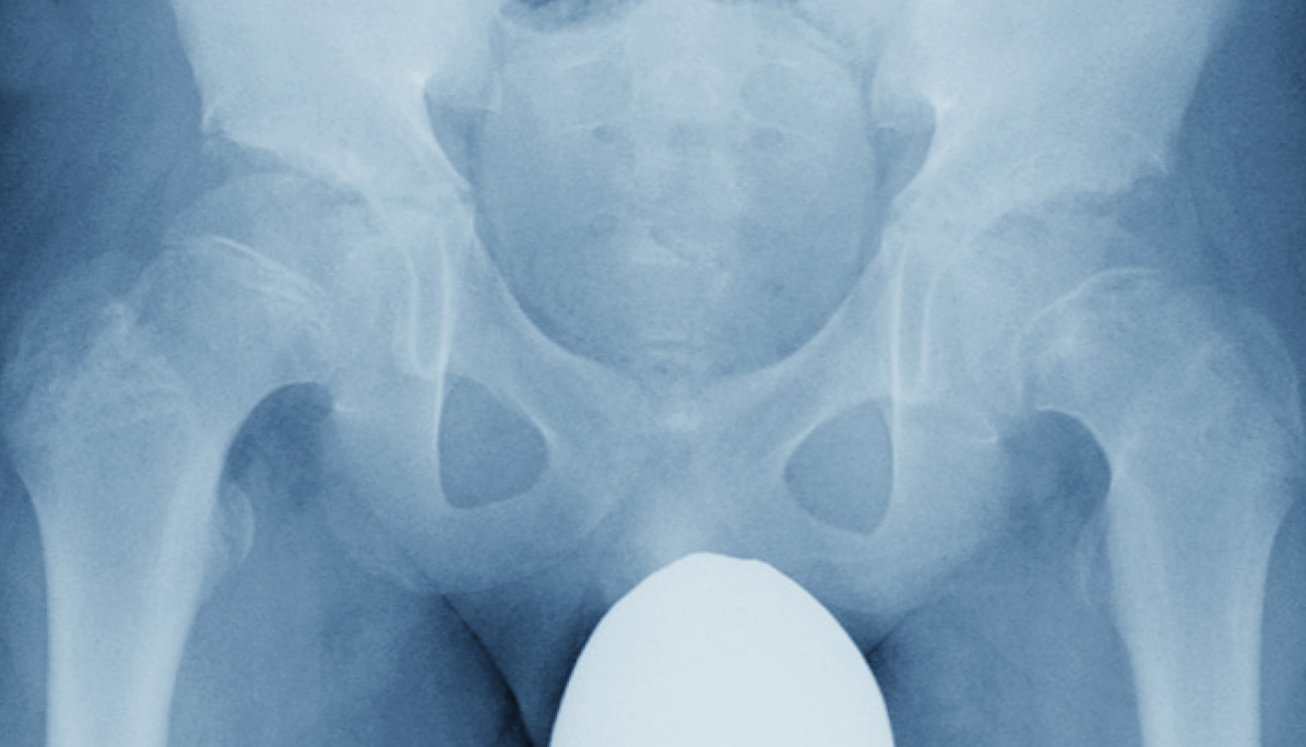 股関節のレントゲン