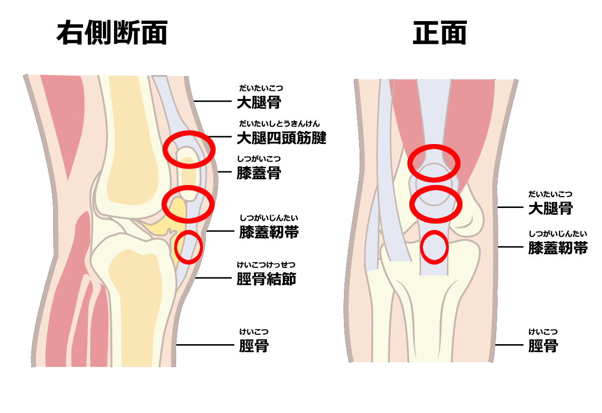 テニス肘・ゴルフ肘