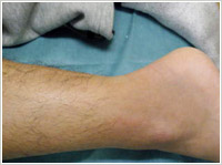 アキレス腱断裂保存療法