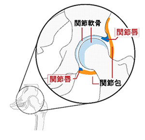 変形性股関節症