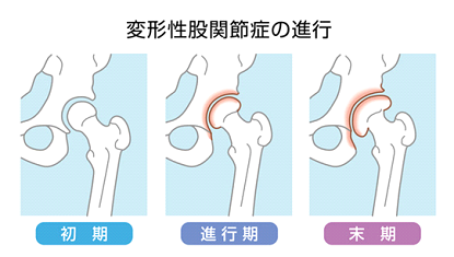 変形性股関節症