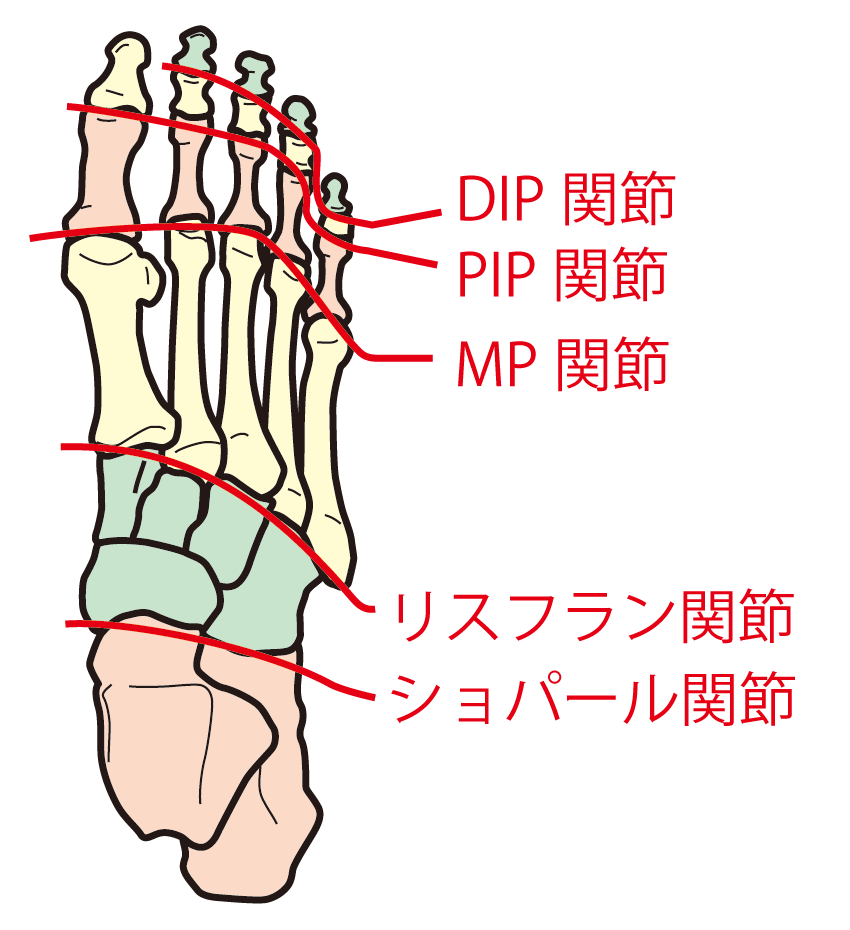 リスフラン靭帯損傷