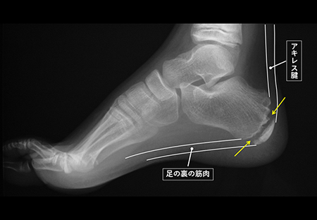 セーバー病、シーバー病、Sever病