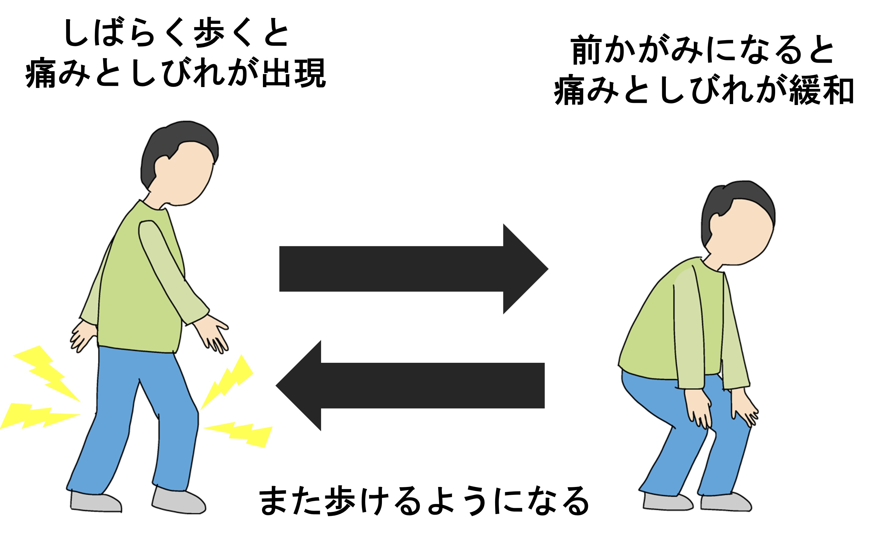 腰部脊柱管狭窄症