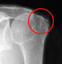 腱板断裂関節症